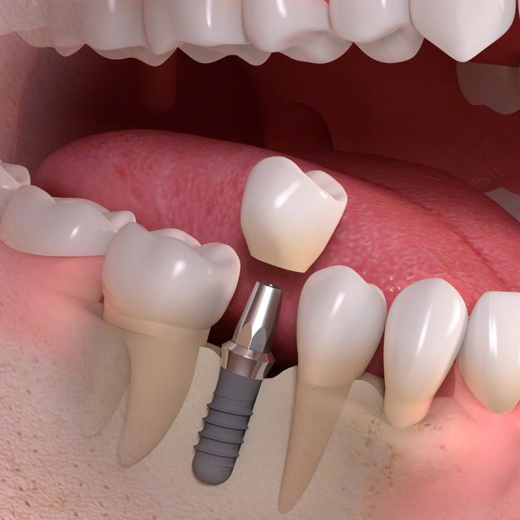 Imagem de implante dentário